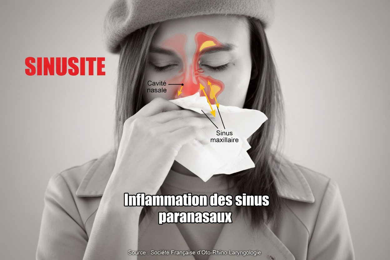 Une femme souffre d’une infection fongique nasale liée à une habitude quotidienne