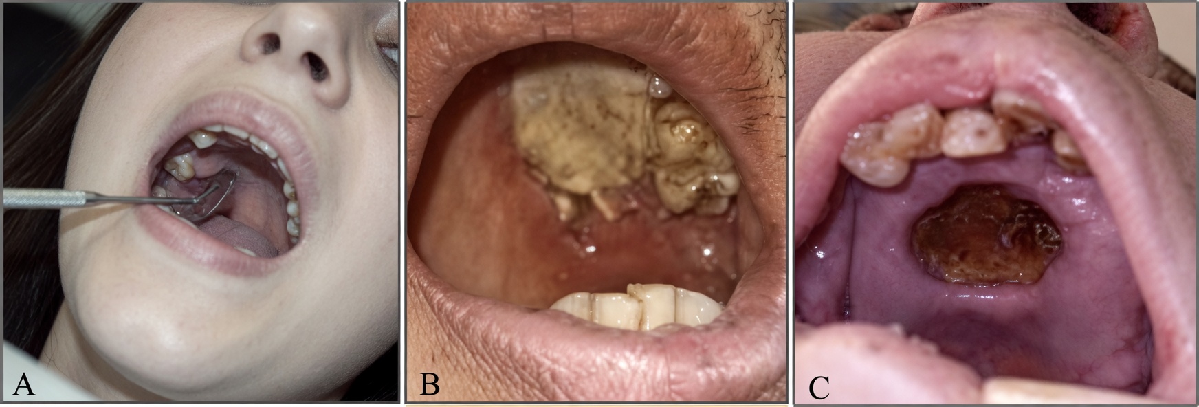 Une femme souffre d’une infection fongique nasale liée à une habitude quotidienne