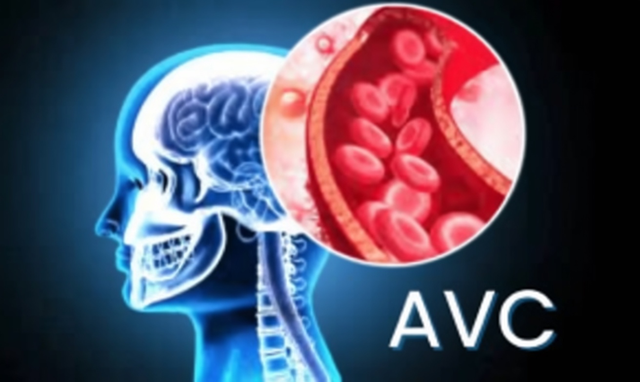 7 Signes avant-coureurs d’un AVC lacunaire chez les personnes de plus de 60 ans que tout le monde néglige, surtout le numéro 4