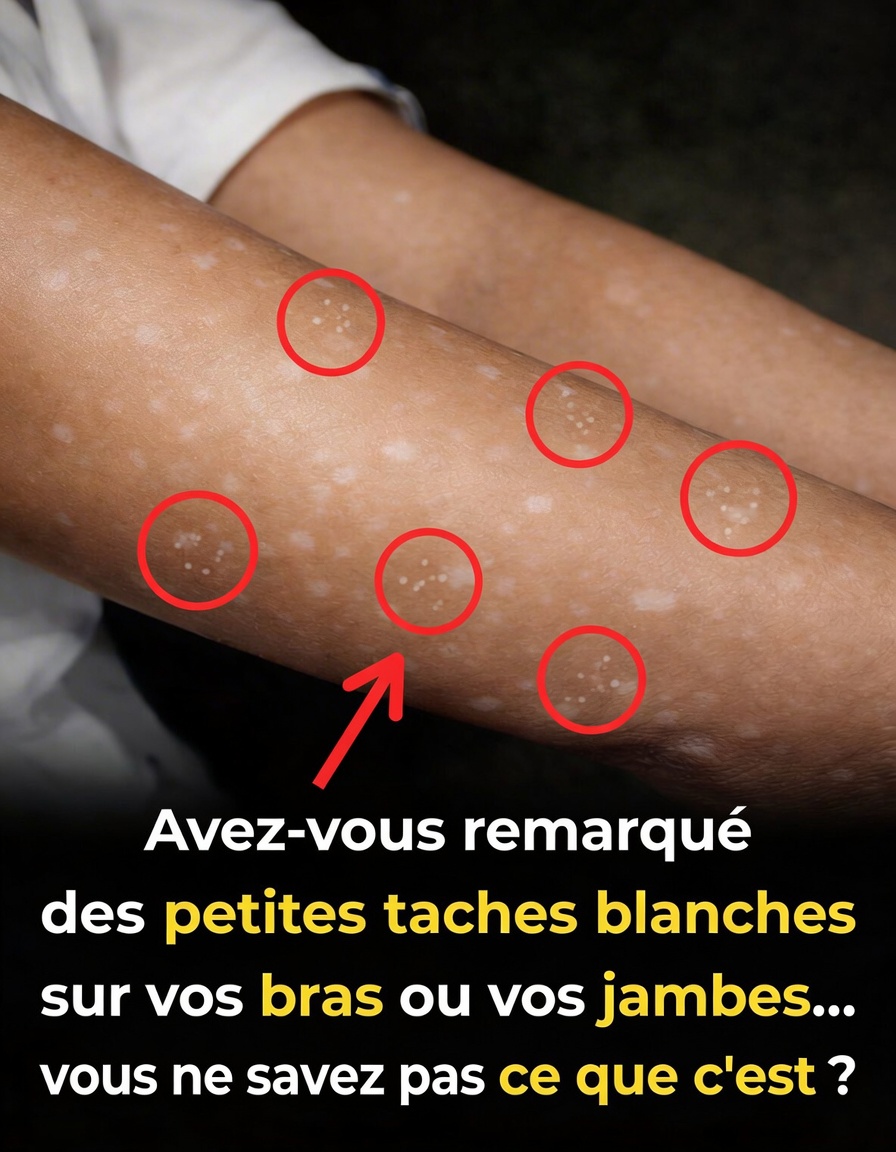Avez-vous remarqué de petites taches blanches sur vos bras ou vos jambes… sans savoir ce que c’est ?