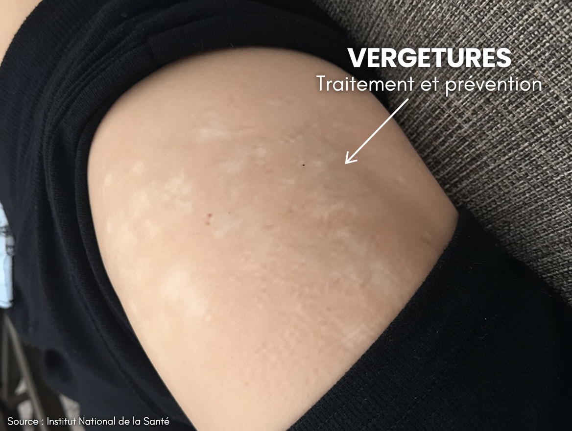 Avez-vous remarqué de petites taches blanches sur vos bras ou vos jambes… sans savoir ce que c’est ?