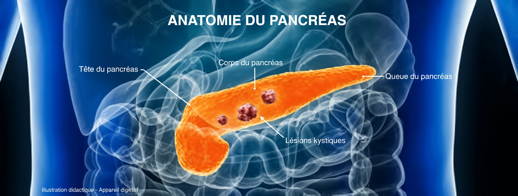 12 signes avant-coureurs précoces du cancer du pancréas à ne jamais ignorer et comment les reconnaître