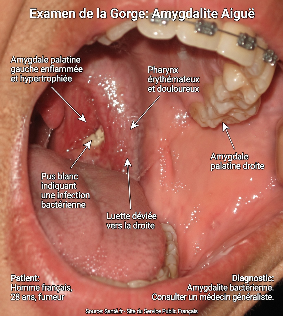 Calculs amygdaliens : découvrez ce qu’ils sont, comment ils apparaissent et comment vous en débarrasser pour toujours