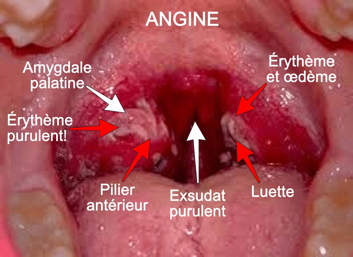 Calculs amygdaliens : découvrez ce qu’ils sont, comment ils apparaissent et comment vous en débarrasser pour toujours