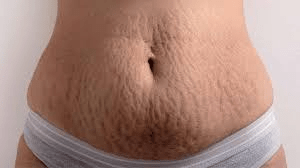 Vergetures chez les femmes : comprendre les causes, les stratégies de prévention au quotidien et comment les assumer avec confiance