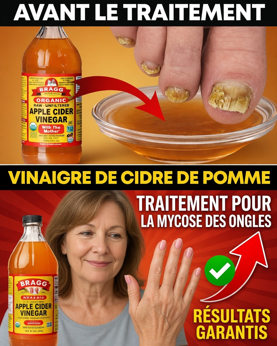 Traitement de la mycose des ongles des pieds avec du vinaigre de cidre : un remède rapide et bon marché