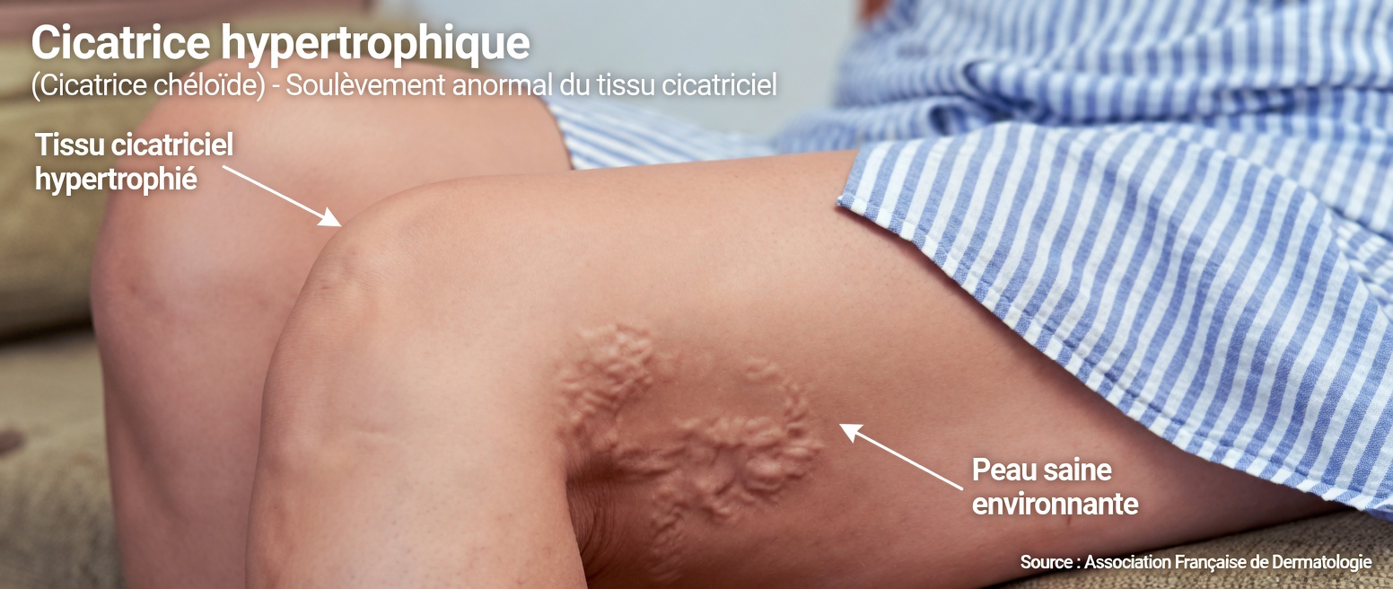 Remède naturel de grand-mère contre les varices