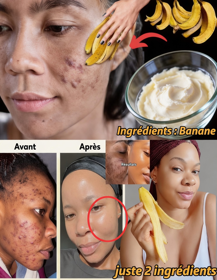 7 façons naturelles d’atténuer les ridules et d’illuminer la peau avec des pelures de banane