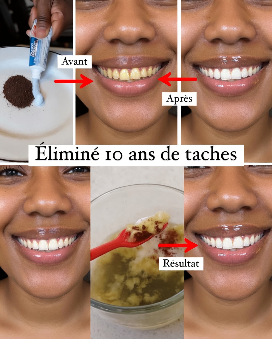 En seulement 2 minutes, éliminez 10 ans de taches dentaires – le blanchisseur naturel qui fonctionne vraiment
