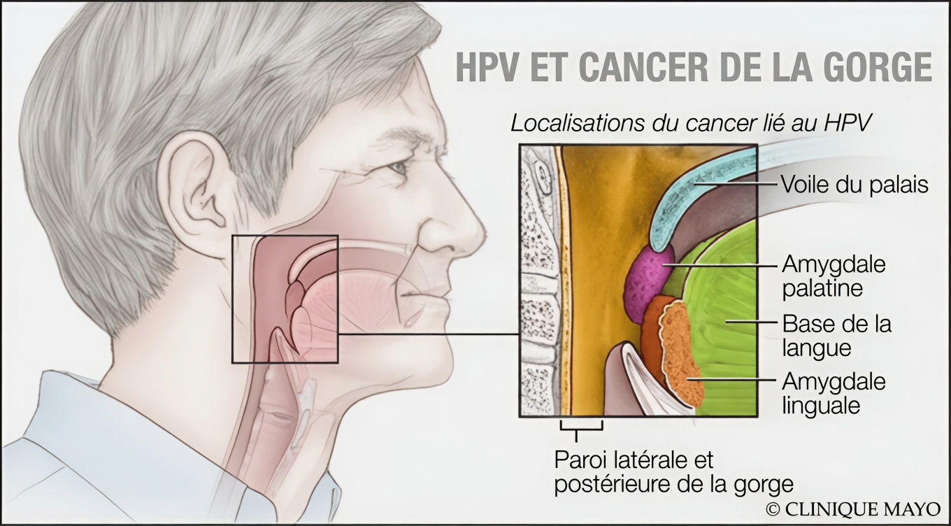Quels sont les symptômes courants du HPV dans la gorge ? Signes clés à connaître