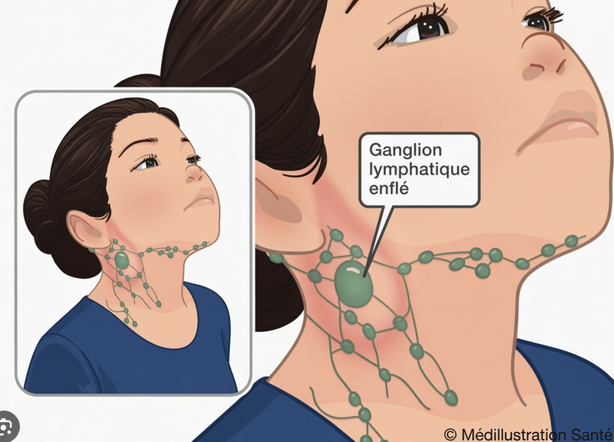 Quels sont les symptômes courants du HPV dans la gorge ? Signes clés à connaître