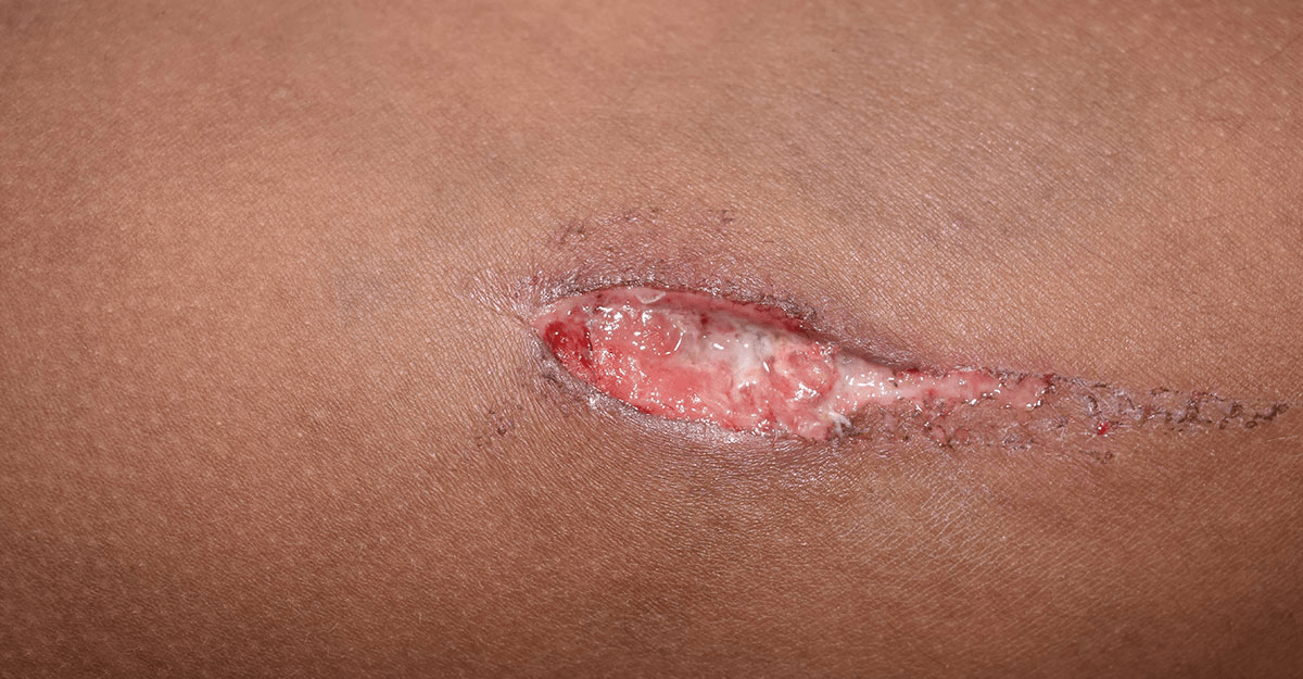 Signes que vous avez trop de sucre dans le sang…voir plus