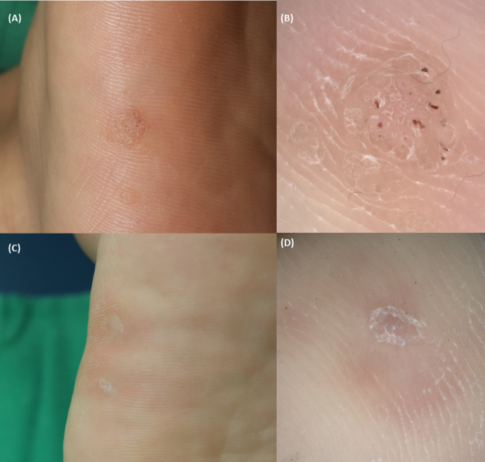 La peau de banane peut-elle vraiment aider à éliminer les verrues ? Un regard bienveillant sur ce remède maison simple