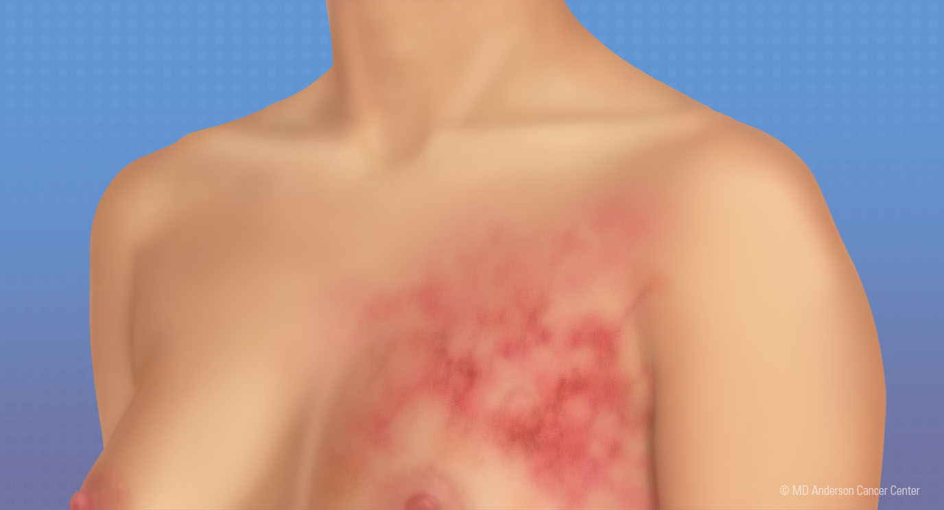 10 Signes Avant-coureurs du Cancer du Sein : Une Détection Précoce Pourrait Vous Sauver la Vie