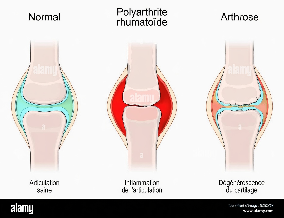 Soulagement rapide ! Cela atténuera naturellement les douleurs articulaires
