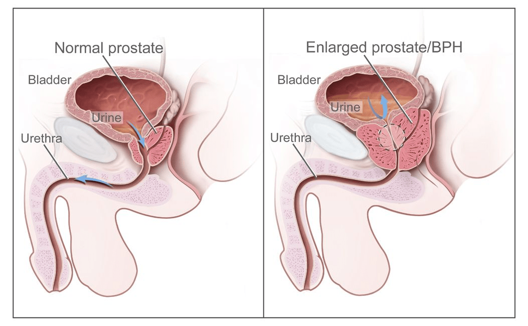 Quelles habitudes quotidiennes peuvent contribuer aux problèmes de prostate augmentée chez les hommes de plus de 50 ans et comment y remédier ?