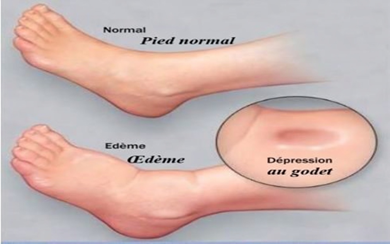 Comment vos pieds vous avertissent de problèmes de foie : ne manquez pas ces signes subtils