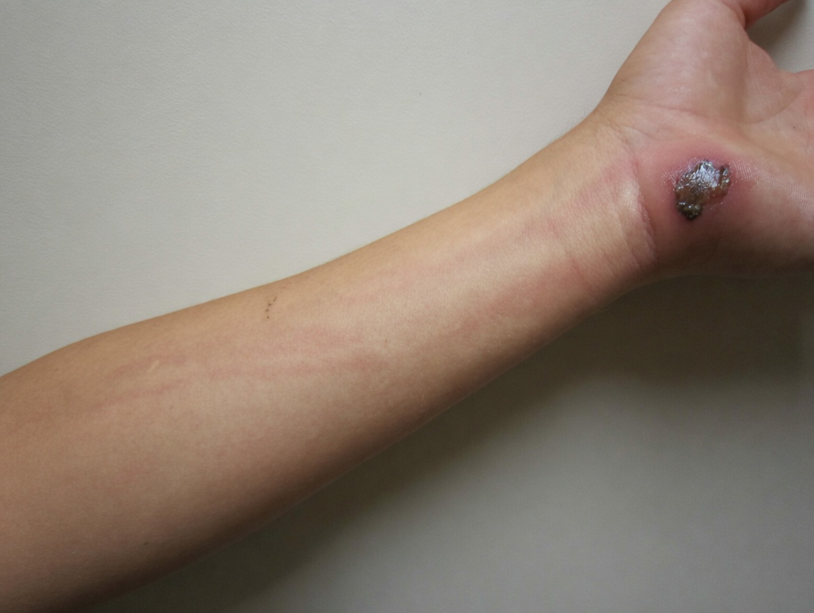 Plaie douloureuse avec un centre sombre sur le mollet : un avertissement cutané à ne pas ignorer