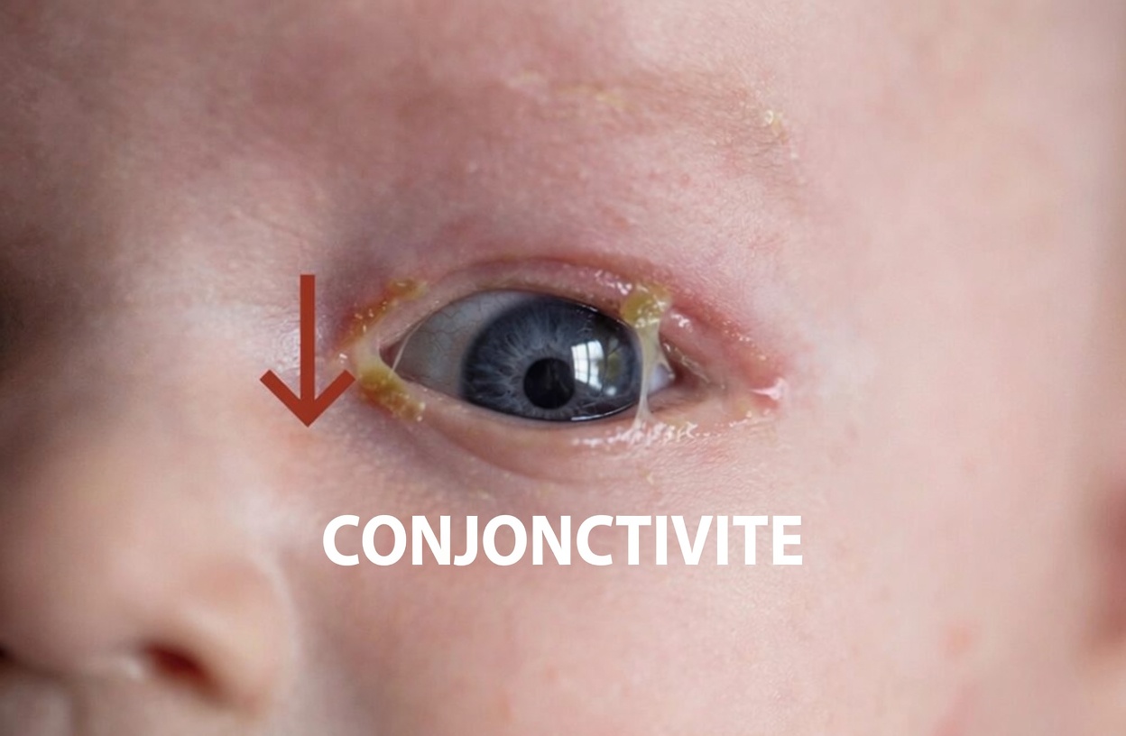 Œil du tout-petit collé par des sécrétions jaunes ? Conseils doux de nettoyage à la maison que les parents devraient connaître