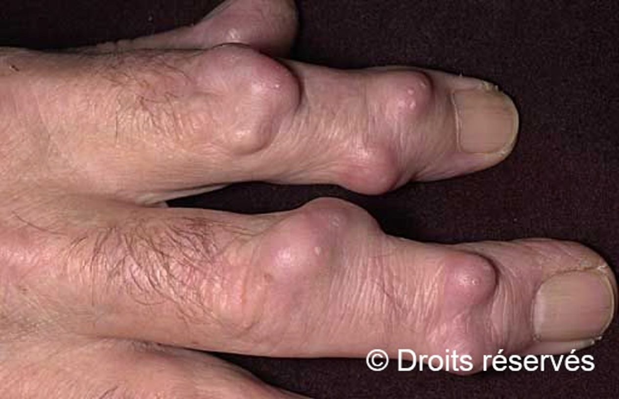 Une étrange bosse au poignet apparue du jour au lendemain ? Ce que les personnes âgées devraient savoir