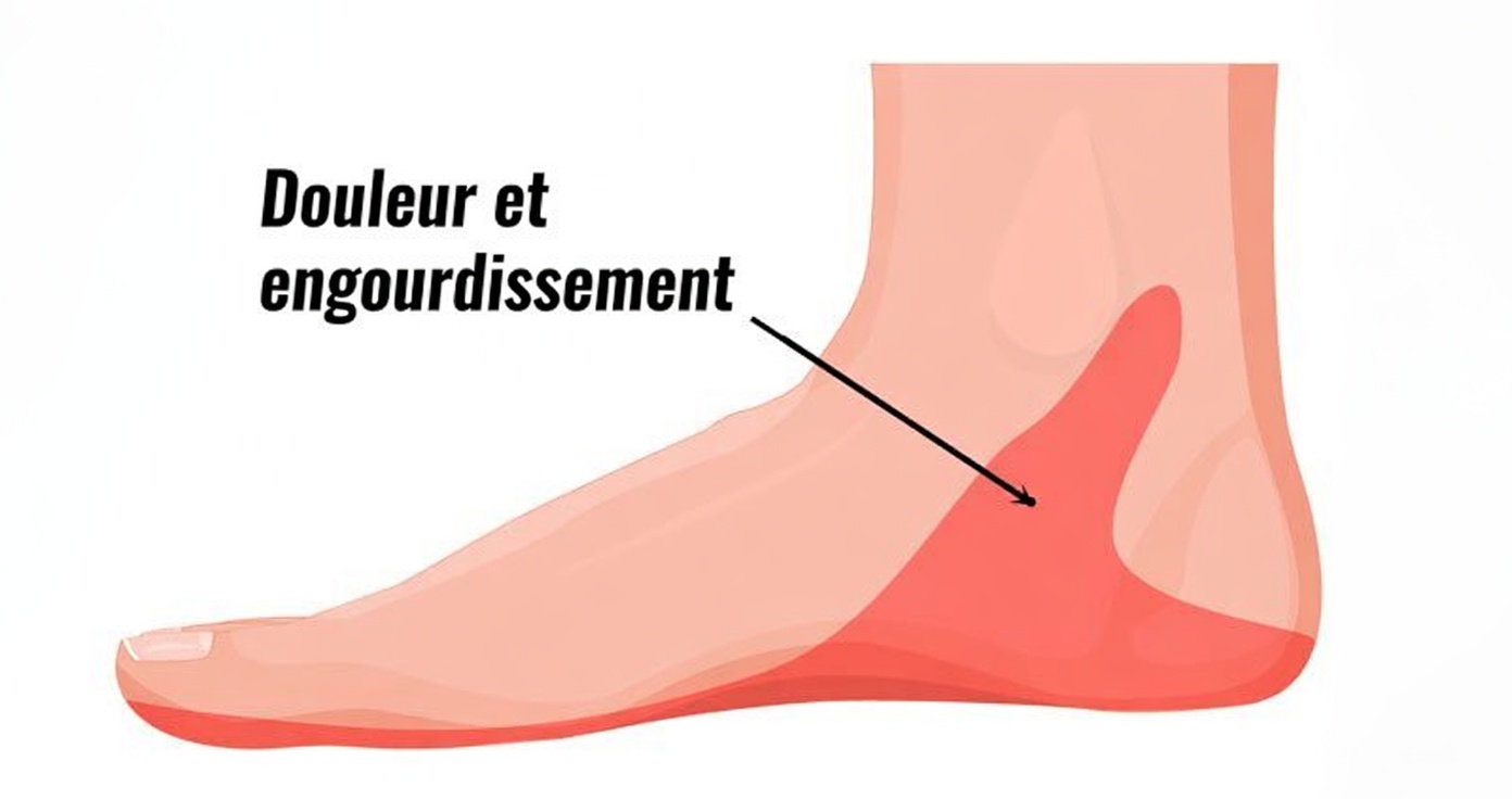 Comprendre l’engourdissement et la douleur au pied : exploration de 3 problèmes de santé courants à ne pas négliger
