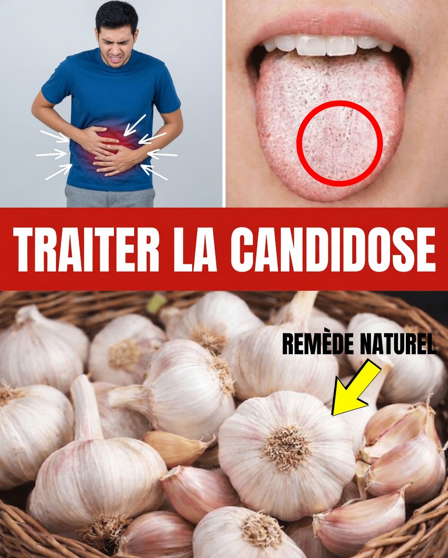 Dites adieu au Candida : 8 remèdes naturels qui peuvent aider à le gérer durablement