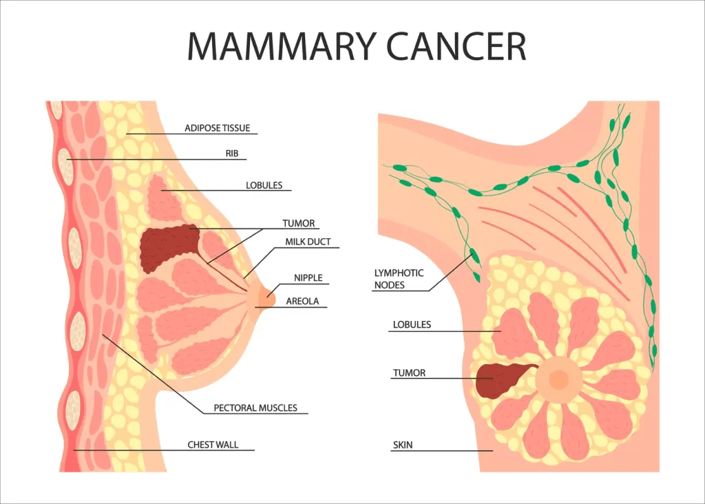 Quels sont les 10 signes d’alerte courants du cancer du sein que tout le monde devrait connaître pour un dépistage précoce ?