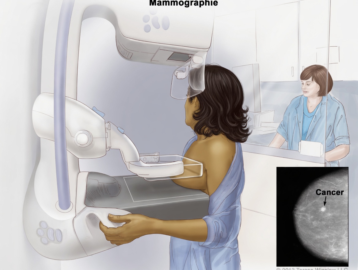 Quels sont les 10 signes d’alerte courants du cancer du sein que tout le monde devrait connaître pour un dépistage précoce ?