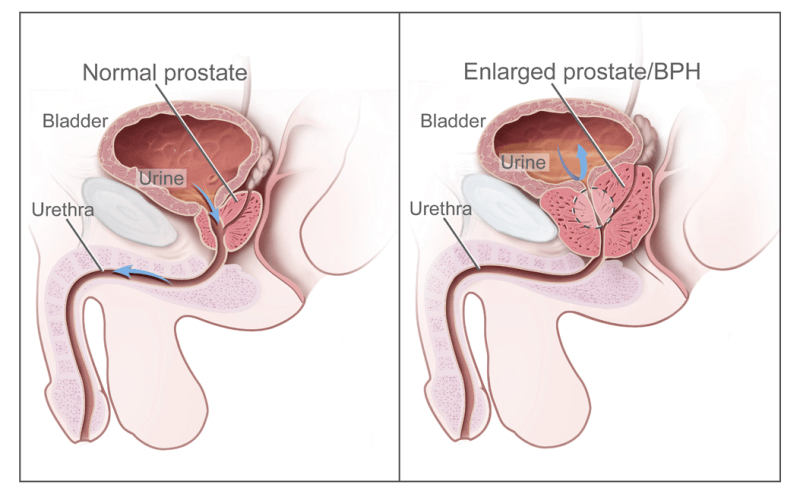 Le fait de renoncer aux dépistages du cancer de la prostate pourrait-il augmenter le risque de mortalité ? Informations clés pour les hommes de plus de 50 ans