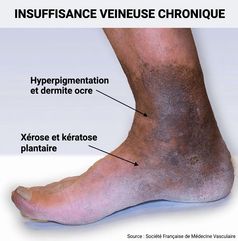 7 signes avant-coureurs d’artères obstruées dans vos jambes et vos pieds – N’ignorez pas ces signaux silencieux