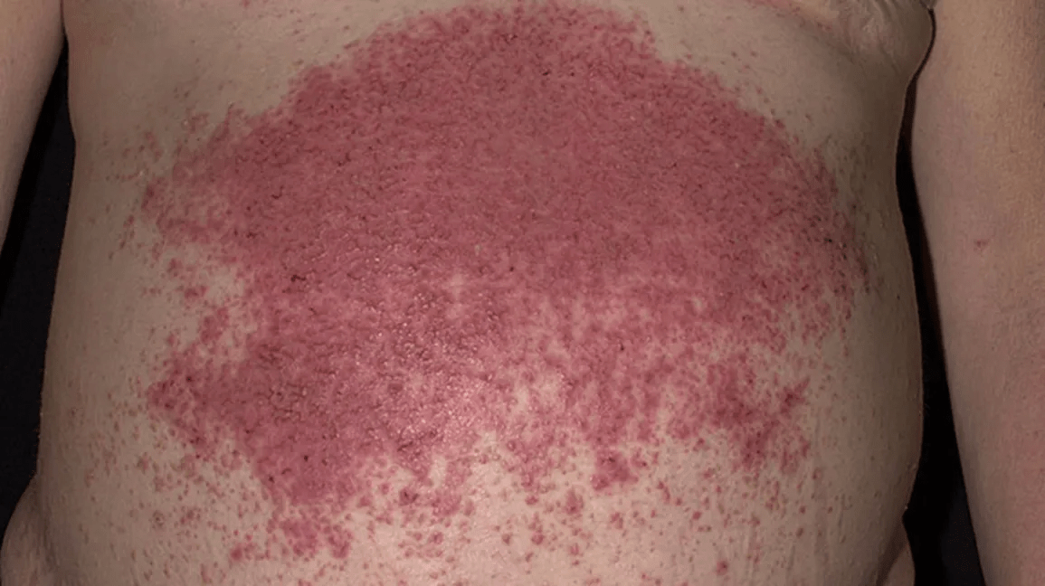 Que faire si votre mère a une éruption vésiculeuse qui fait le tour de son flanc : conseils de confort à domicile en attendant les urgences