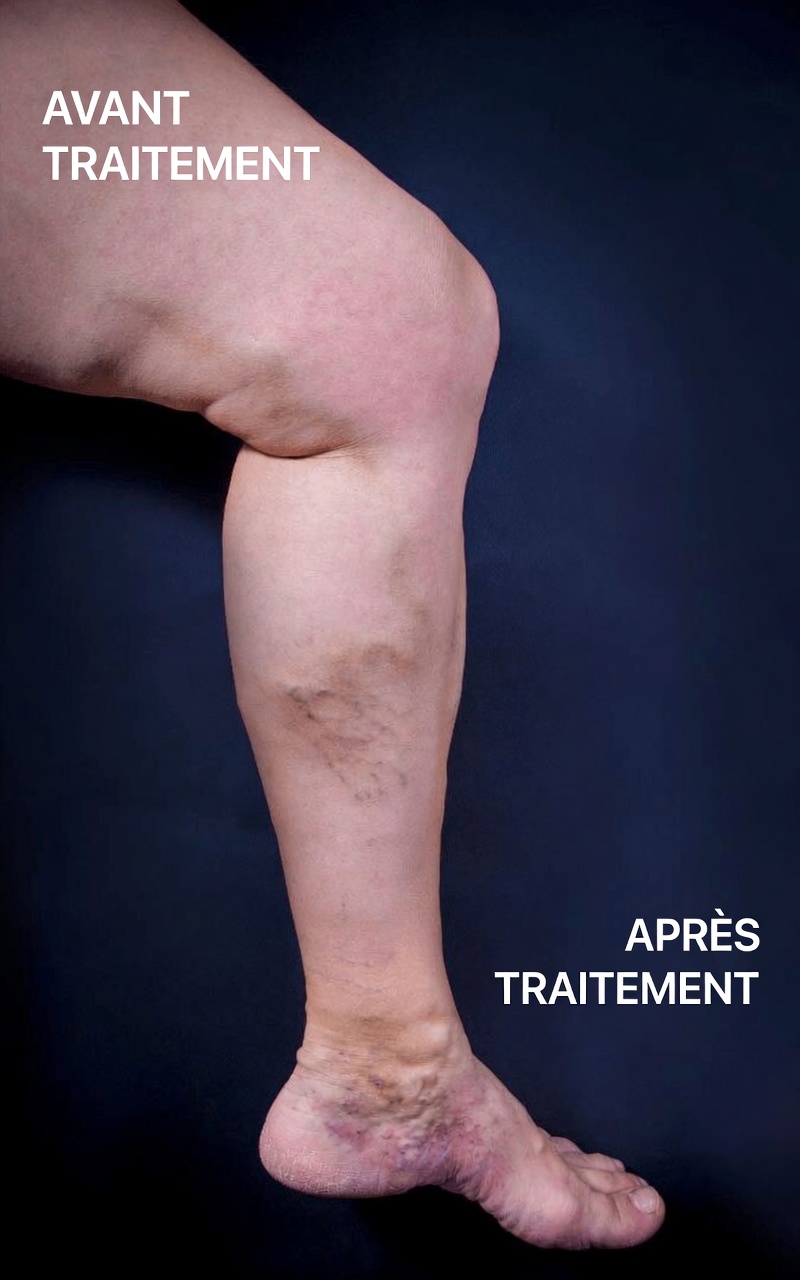 Quand des veines gonflées peuvent signaler une insuffisance veineuse chronique, des problèmes cardiaques ou pulmonaires, ou un risque de caillot