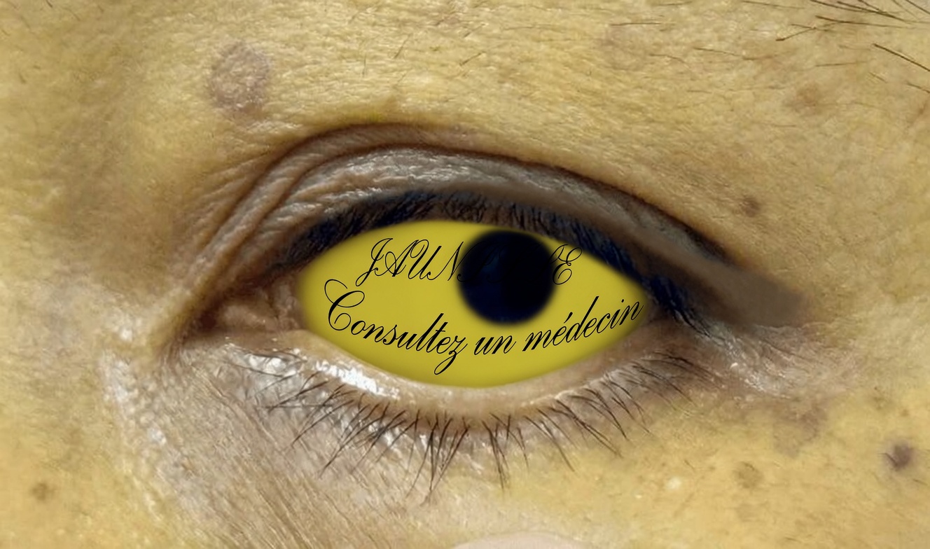 10 signes avant-coureurs du cancer du pancréas à ne jamais ignorer