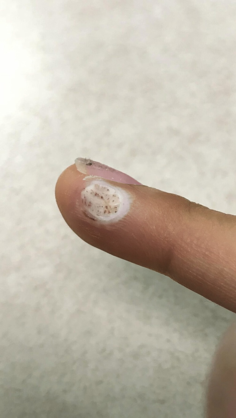 Le peroxyde d’hydrogène peut-il aider à traiter les verrues ? Utilisations pratiques, conseils de sécurité et à quoi s’attendre à la maison