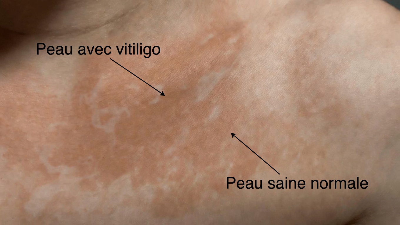 Pourquoi des taches blanches apparaissent-elles sur votre peau ? Causes fréquentes et ce qu’il faut savoir