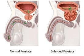 Pourquoi négliger les examens réguliers de la prostate peut accroître le risque de cancer de la prostate chez les hommes de plus de 40 ans