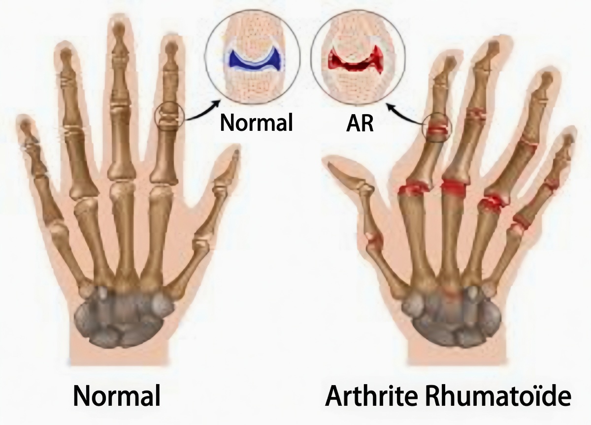 Prise en charge de la polyarthrite rhumatoïde : nouveaux médicaments et dernières avancées de la recherche expliquées clairement — ce que les patients doivent savoir en 2026
