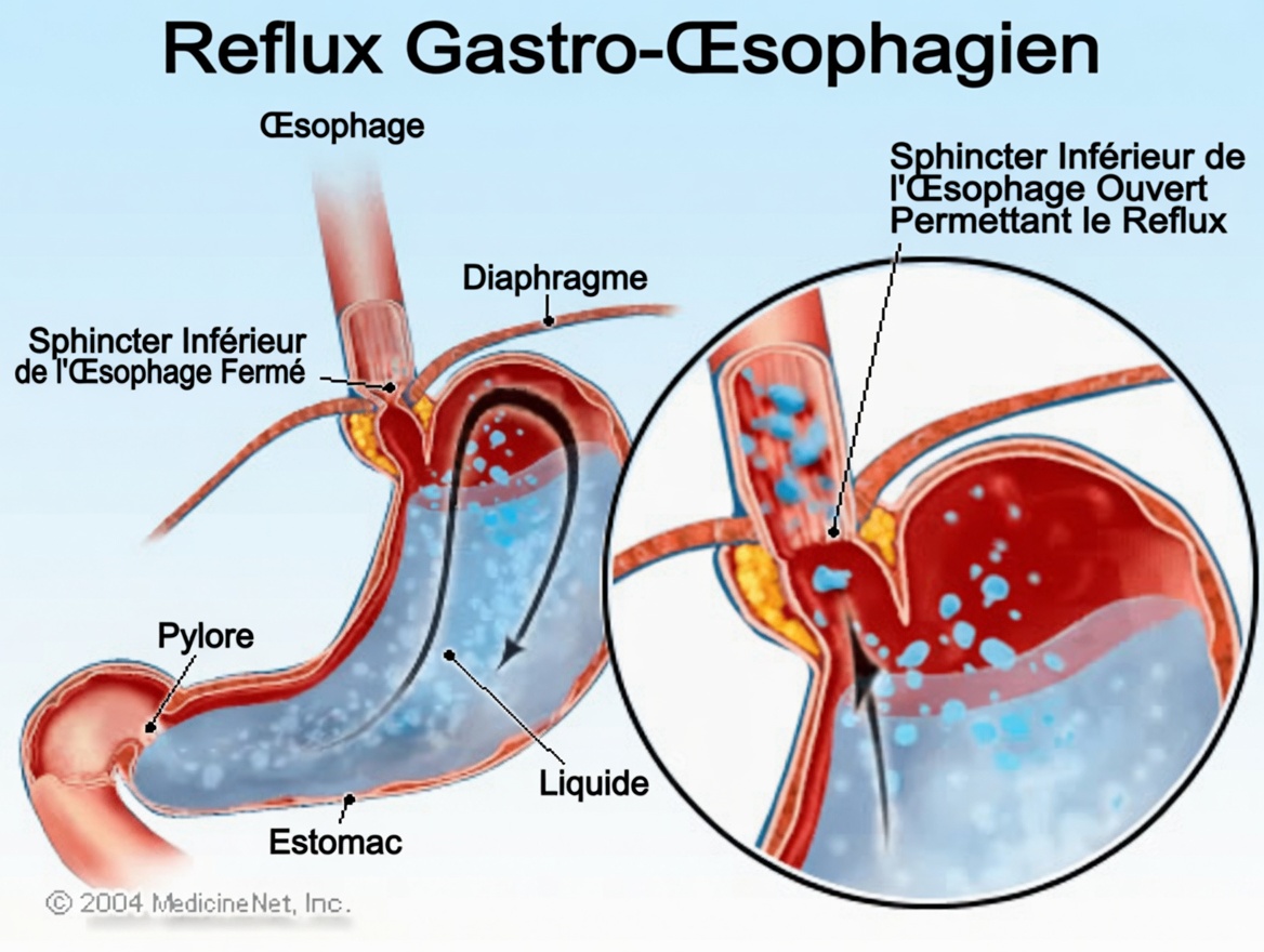 10 signes et symptômes de hernie hiatale à connaître pour une meilleure compréhension digestive