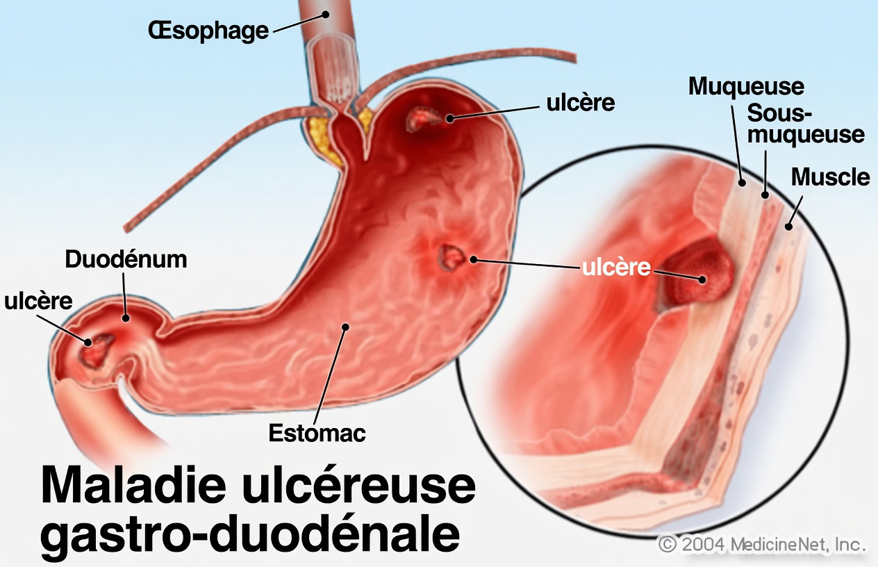 Pourquoi votre ulcère peut ne pas s’améliorer : des habitudes alimentaires quotidiennes qui peuvent ralentir la guérison de l’estomac