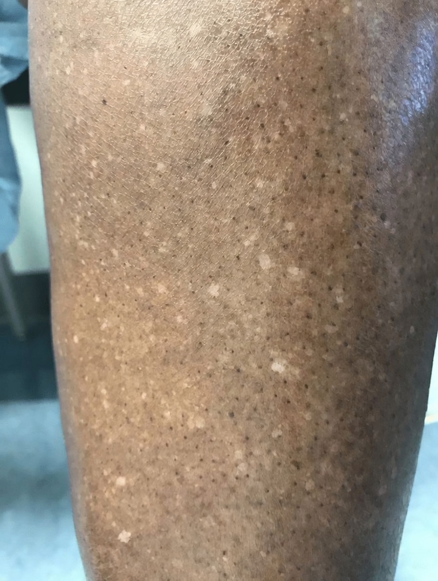 Pourquoi des taches blanches apparaissent-elles sur votre peau ? Causes courantes et ce qu’il faut savoir