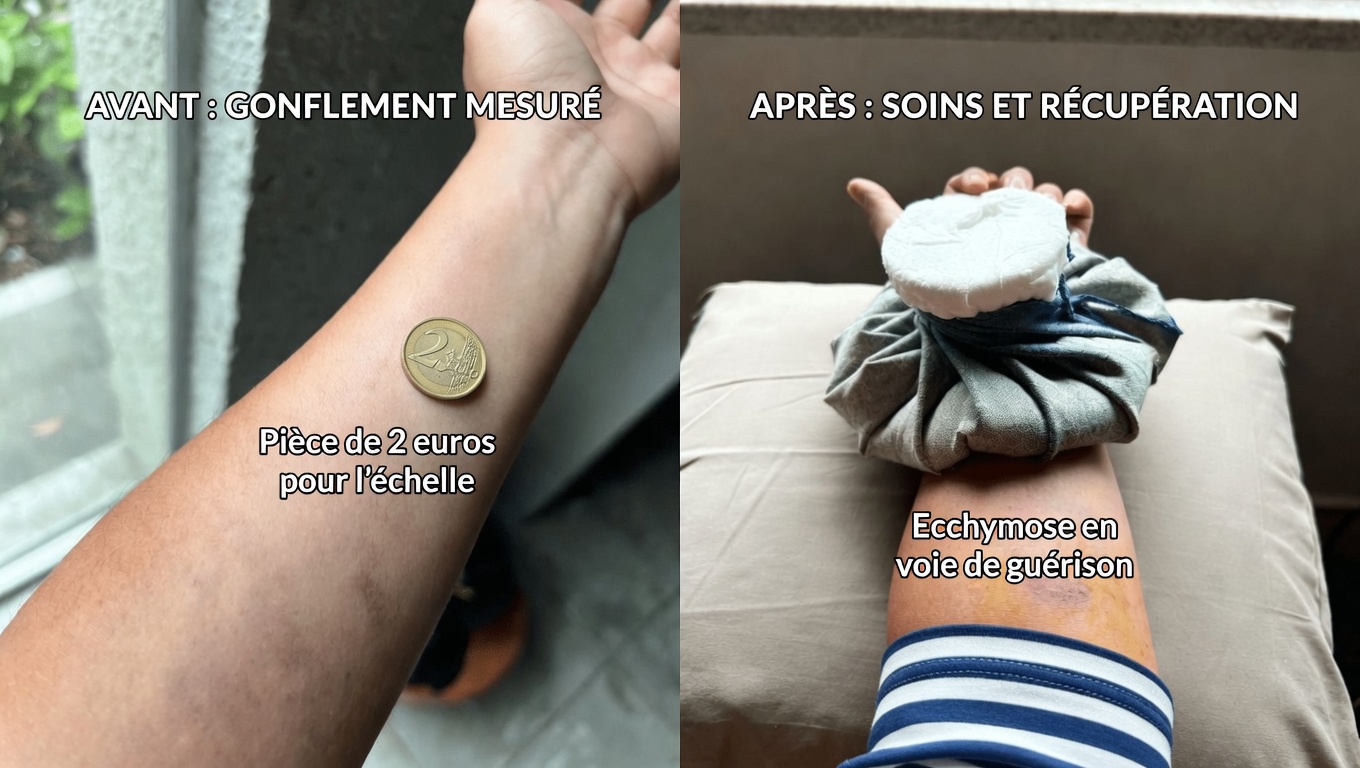 Des ecchymoses violet foncé continuent d’apparaître sur mes bras – que puis-je faire en attendant de consulter un médecin ?