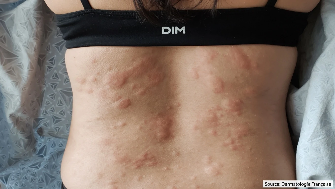Déclencheurs inattendus de l’urticaire que vous ne connaissez peut-être pas — et quoi faire ensuite