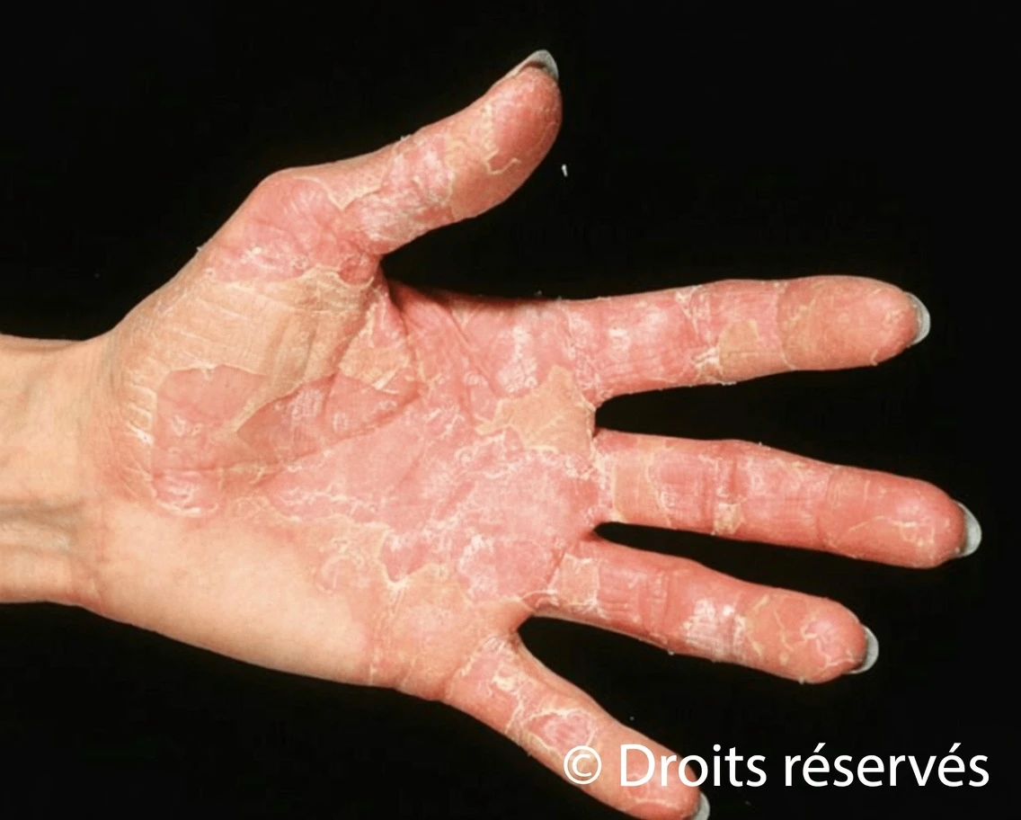 Et si cette peau sèche et qui pèle sur vos mains essayait de vous dire quelque chose d’important ?