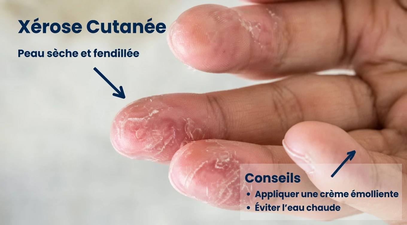 Si cela apparaît sur vos mains, ne l’ignorez pas : les premiers signes de dermatite des mains que vous devez connaître