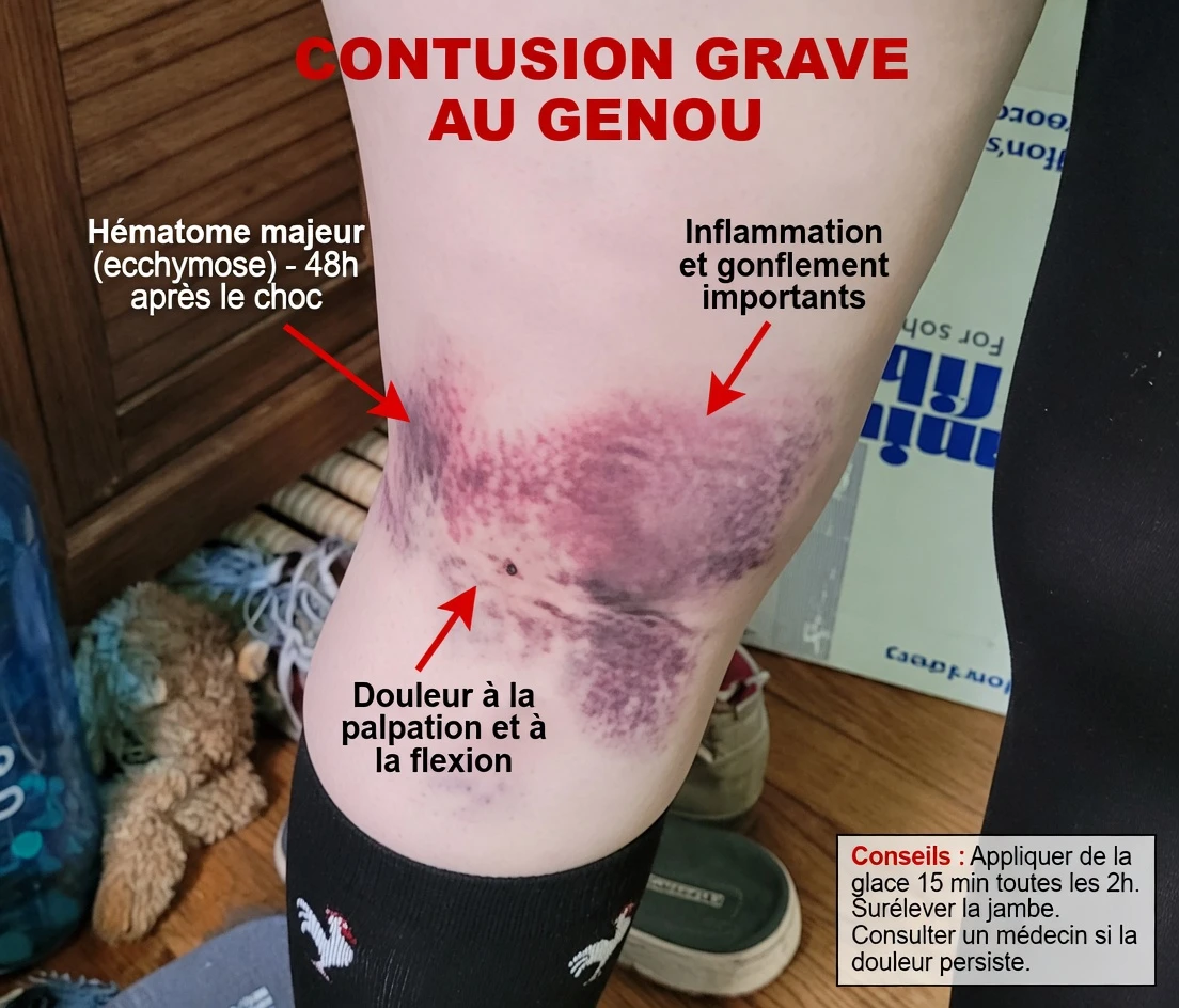 10 signes avant-coureurs subtils du cancer du pancréas à ne pas ignorer