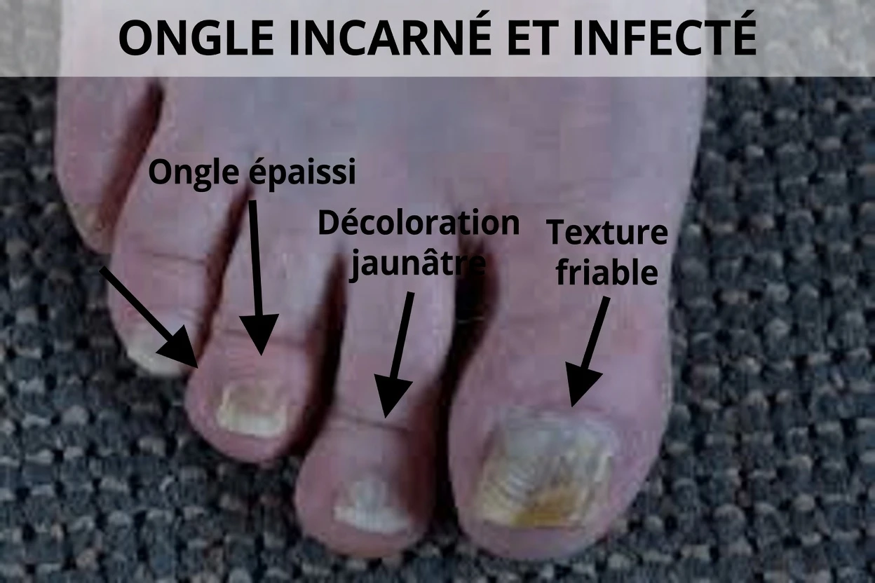 Que faire dès maintenant si vos ongles des pieds deviennent plus épais et jaunes (en attendant de voir le médecin)